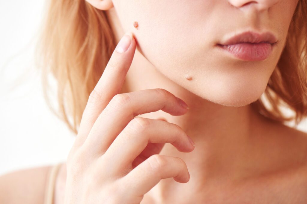 Skin Moles: What Are They?