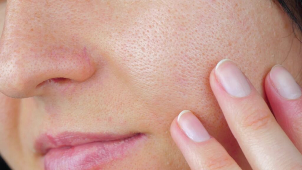 “Pore-fection: 6 Expert Tips for Minimizing Your Pores
