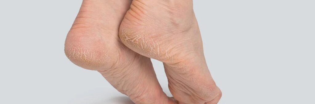 How to fix cracked heels at home