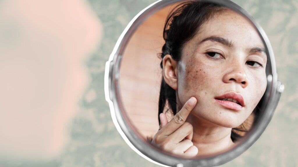 Skincare Guide: How to remove black spots at home