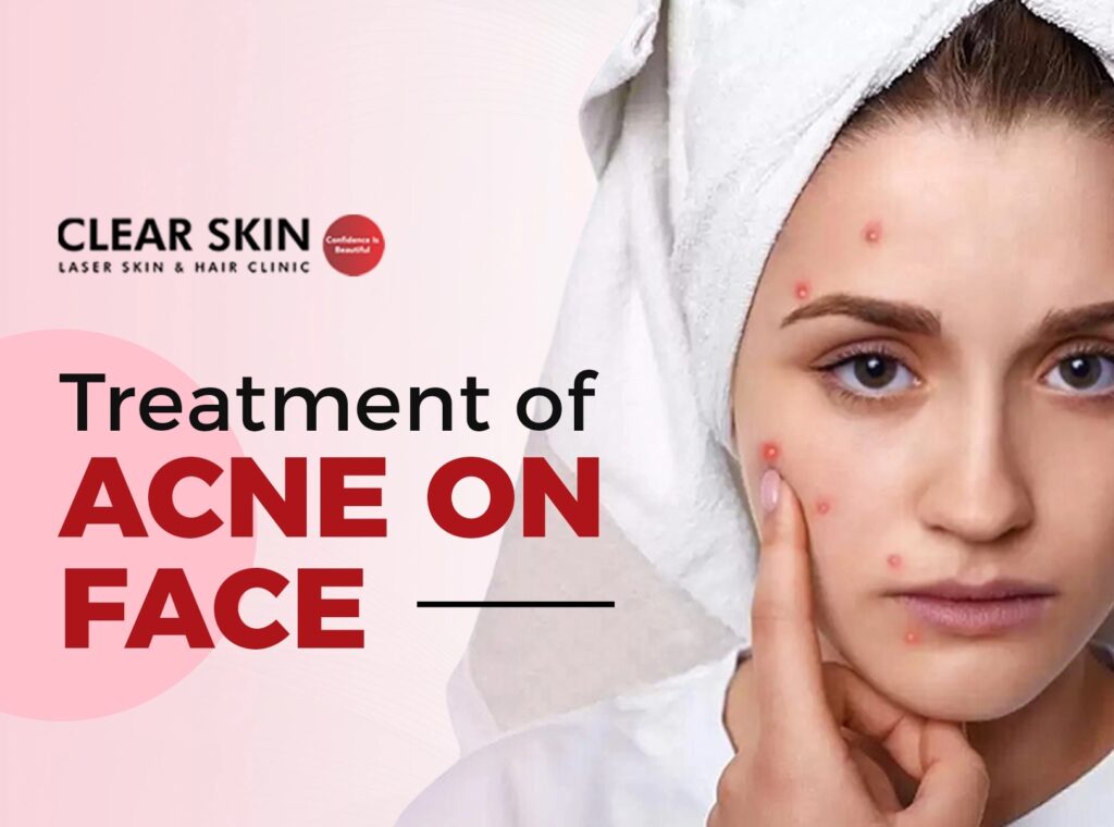 Acne on Face Treatment That Works: Your Guide to Clearer Skin